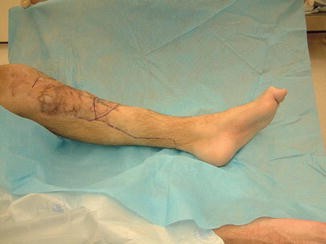 Management of Compartment Syndrome and Crush Syndrome