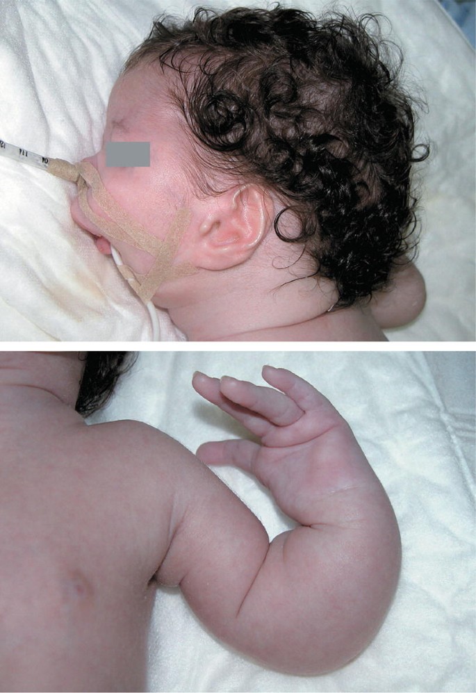 A Case of Rubinstein-Taybi Syndrome with Tetralogy of Fallot