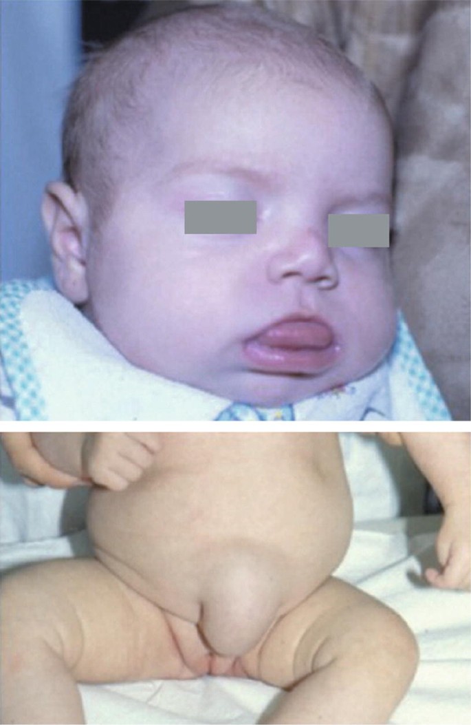 A Case of Rubinstein-Taybi Syndrome with Tetralogy of Fallot