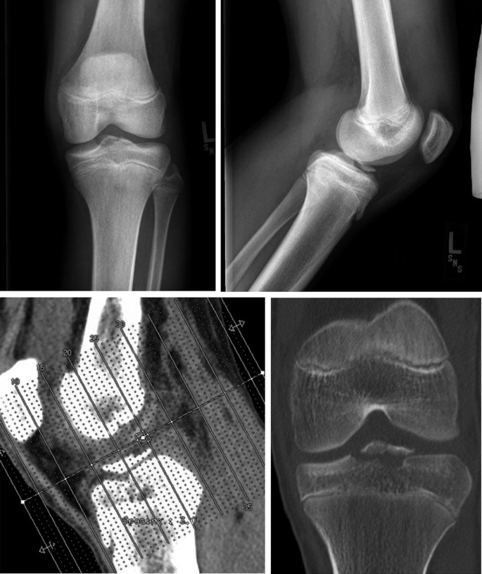 Tibial Spine Fractures  Florida Orthopaedic Institute