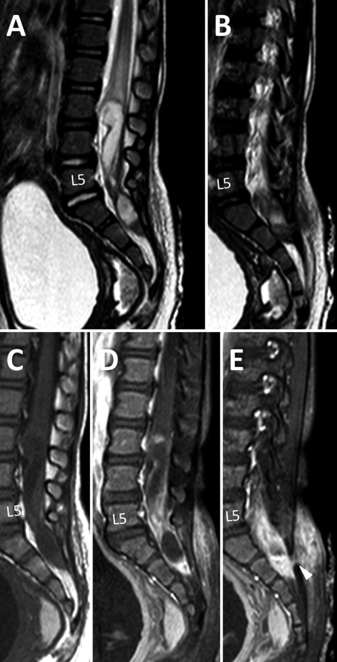 Congenital spinal dermal tract: how accurate is clinical and radiological  evaluation? in: Journal of Neurosurgery: Pediatrics Volume 15 Issue 6  (2015) Journals