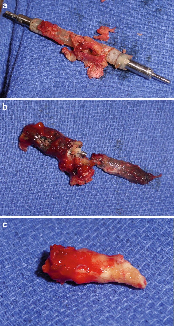 Fotos de corte no braço? Como os BraceTop Evitam Lesões Durante Atividades  Cotidianas, image size:685x1279