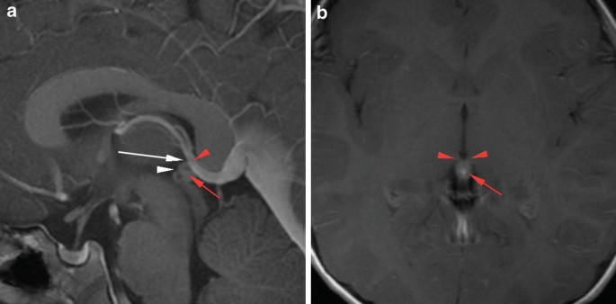 Outcomes and surgical approaches for pineal region tumors in children: 30  years' experience in: Journal of Neurosurgery: Pediatrics Volume 32 Issue 2  (2023) Journals