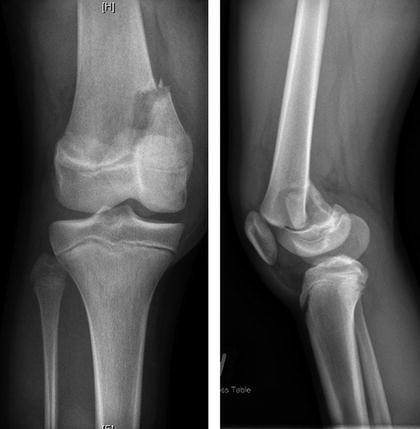Distal Femur Physeal Fracture | SpringerLink