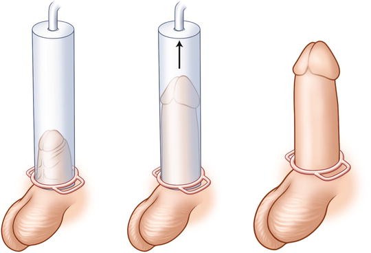 Erectile dysfunction vacuum pumps in the uk