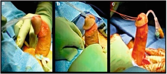reliable bpc 157 source Unraveling the mystery of Peyronie's Disease. Our latest blog post sheds  light on understanding the curve and finding essential support.  https://urocarechennai.com/blog/peyronies-disease-understanding-the-curve-and-finding-support/  #PeyroniesDisease main image 0