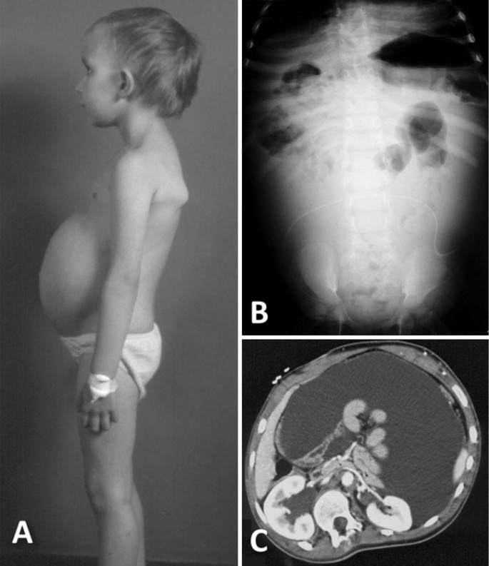 Pathophysiology and Management of Abdominal Complications of  Ventriculo-peritoneal Shunts