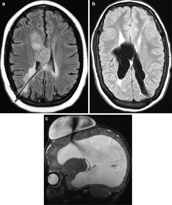 Cerebrospinal shunts - Questions and Answers ​in MRI