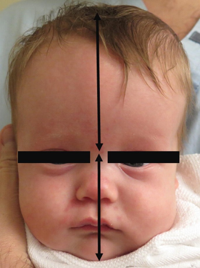 Clinical Findings of Children with Hydrocephalus | SpringerLink