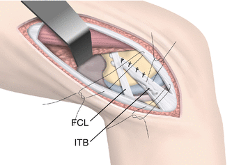 Iliotibial Band Tenodesis, ACL Surgery, ITB Tenodesis, Orthopedic Knee  Surgeon