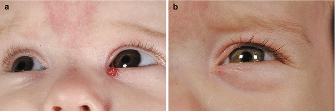 Controversies in the Treatment of Infantile Haemangiomas with β-Blockers |  SpringerLink