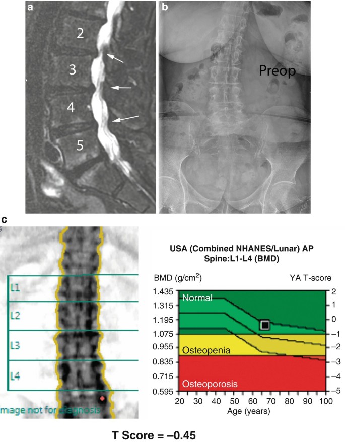 Bilateral hip DXA scan image from a 59-year-old post-menopausal woman.