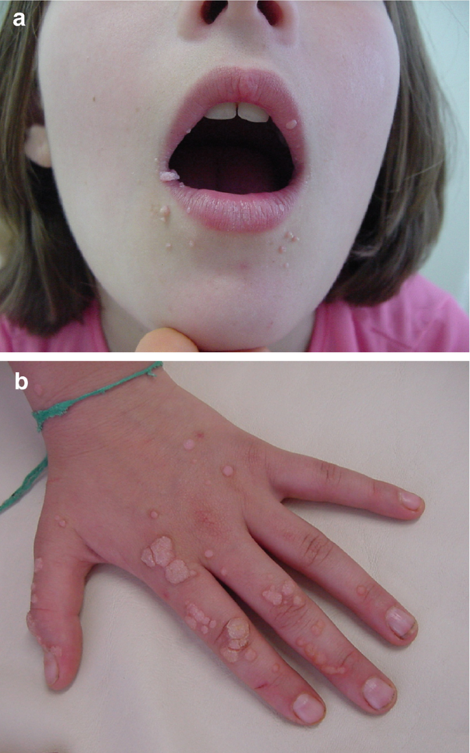 An Adolescent's Exuberant Rash: Is It Hand-Foot-and-Mouth Disease?