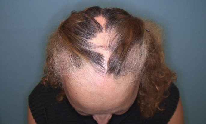 Tinea capitis: grey patch-type showing patchy alopecia with lustreless