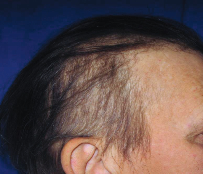 Alopecia | SpringerLink Alopecia | SpringerLink