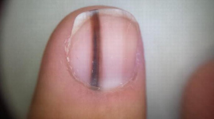 Nail Diseases | SpringerLink Nail Diseases | SpringerLink