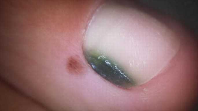 Fungal Skin and Nail Infection — Glide Podiatry Hendra Clinic