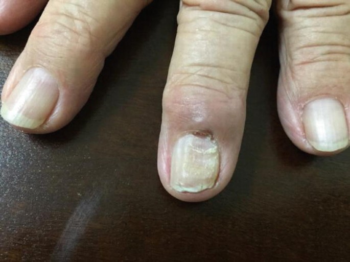 Nail Care -DNHS 2020-2021 - Module 1 Activity 5 Direction: look at the nails  of at least 3 members in your family. Check, analyze, and indentify the  presence of a nail disorder