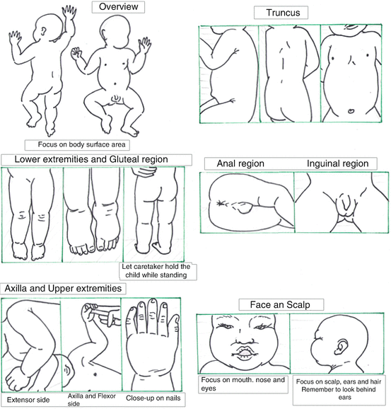 Defining and Assessing Skin Changes in Severe Acute Malnutrition (SAM)