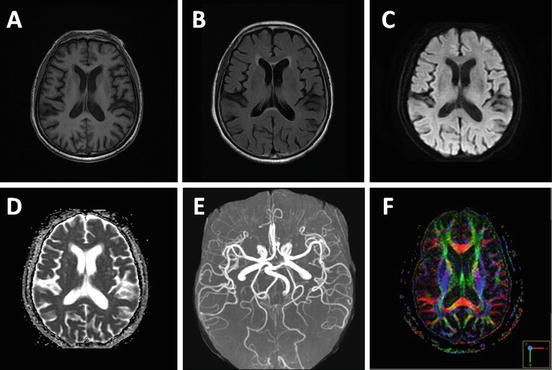 Vitamin B12 Deficiency and Impact on MRI Morphometrics: Association Between  Cognitive Impairment and Neuroimaging Findings | SpringerLink