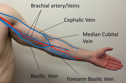 brachial cephalic fistula