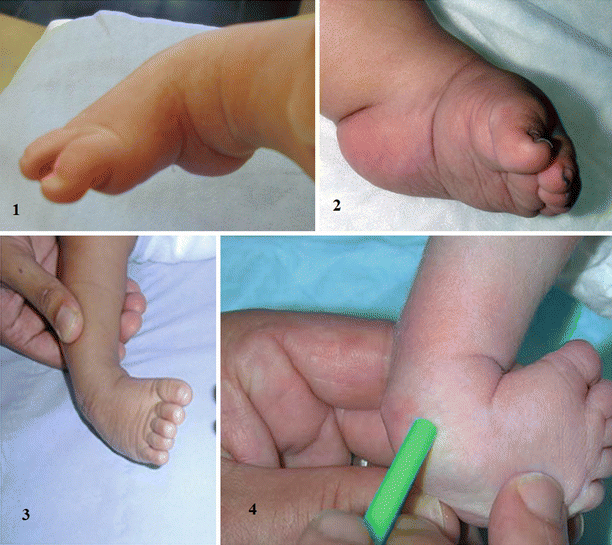 Evidence Based Treatment For Clubfoot Springerlink