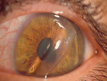 Early (< 3 Months) and Late (> 3 Months) Complications of LASIK |  SpringerLink