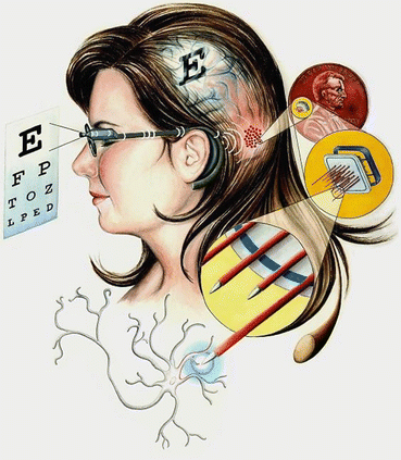 Intracortical visual prosthesis Intracortical visual prosthesis