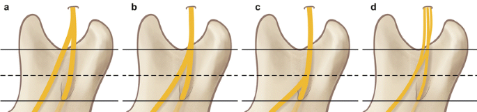 Dental Malpractice Central  Anatomy of the Lingual Nerve