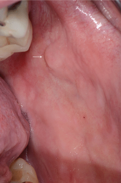 Parotid Glands | SpringerLink