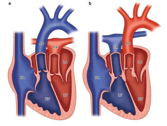 Transposition of the Great Arteries