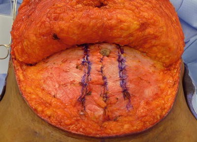 Preoperative photograph of a woman with severe diastasis recti and