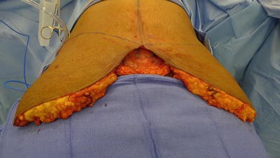 Preoperative photograph of a woman with severe diastasis recti and