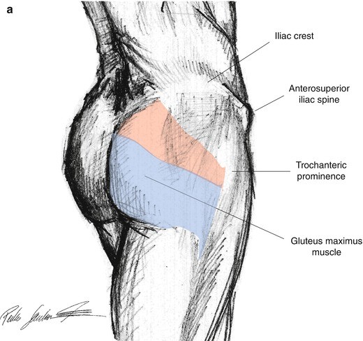 Gluteus Maximus and Surrounding Muscles Injuries