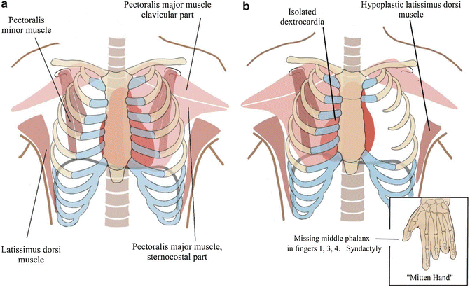 Lil Bone Peep on X: Poland syndrome: disorder w/ unilat missing/ underdeveloped muscles resulting in abnormalities. Affects pec major most  commonly, w/ assoc rib/nipple/breast abnormalities. Also can affect  shoulder, arm, & commonly the
