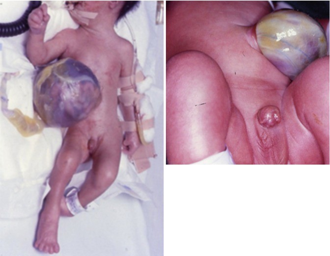 Undescended Testes (Cryptorchidism) | SpringerLink