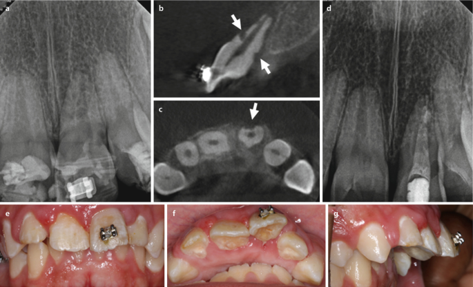 A) Preoperative periapical radiograph of tooth #21. Note the