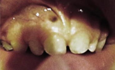 melanotic macule on gums Pigmented Lesions