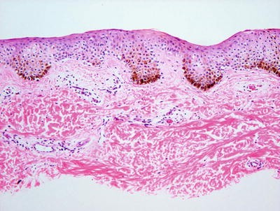 Melanocytic Proliferations and Other Pigmented Lesions | Springer Nature Link Melanocytic Proliferations and Other Pigmented Lesions | Springer Nature Link