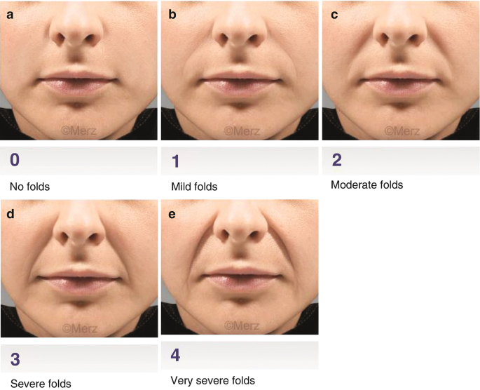 Nasolabial Folds | SpringerLink