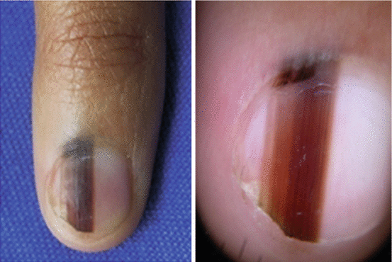 Hutchinson's sign in a nail apparatus melanoma in situ. | Download  Scientific Diagram