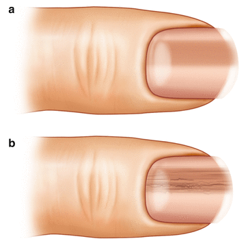 Subungual Melanoma | SpringerLink