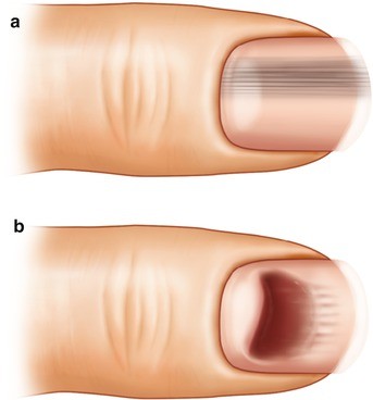 Subungual Melanoma | SpringerLink