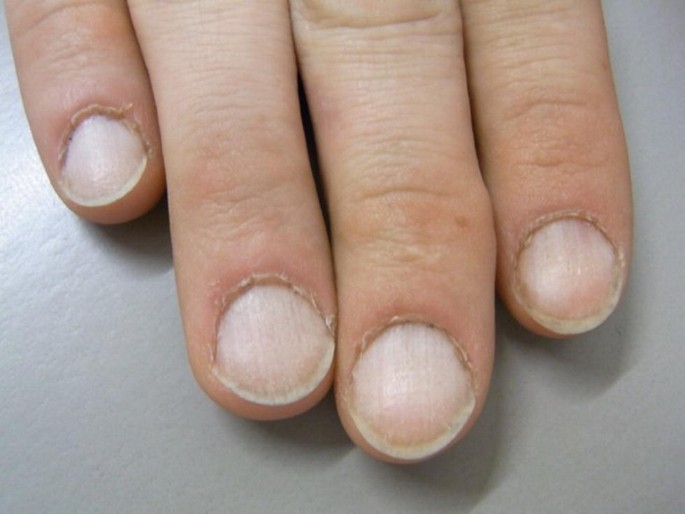Skin and You » Nail Changes