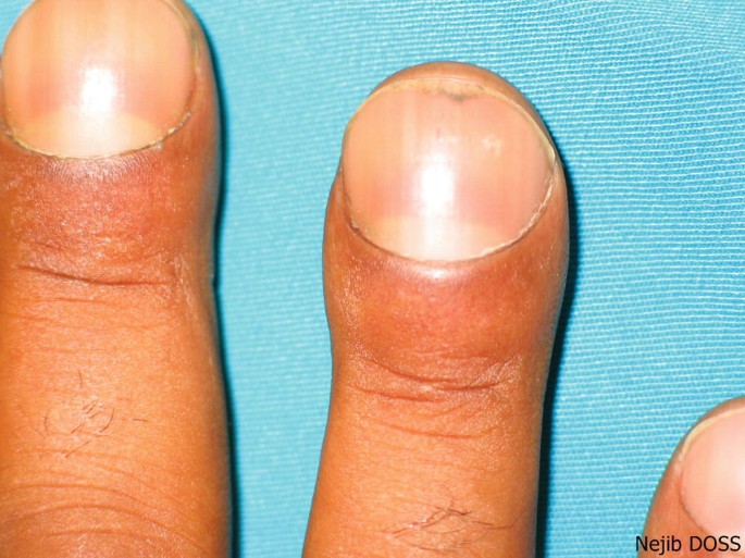 Erosion of nails following thallium poisoning: a case report | Occupational  & Environmental Medicine
