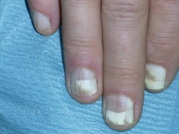 Taxan-associated nail toxicity | BMJ Case Reports