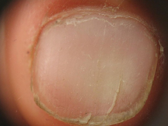 My thumb nail has ridges. : r/mildlyinteresting