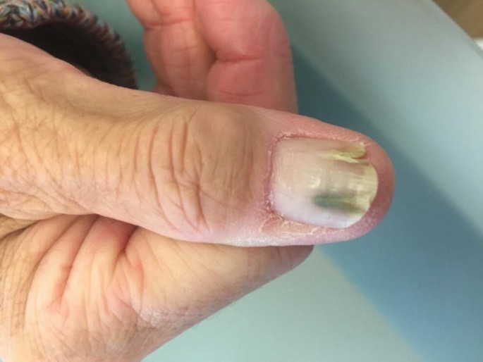 Is green nail syndrome dangerous? - Quora