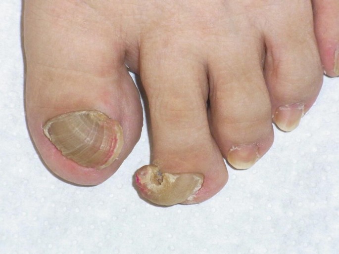 Ingrown Nails (Onychocryptosis, Ingrown toenails) - Dermatology Advisor