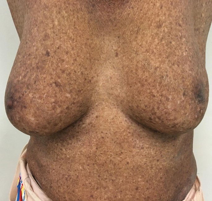 There were macules and papules under her breast bilaterally.